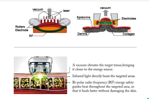 Screenshot 2024-07-31 at 13-58-31 China Vela shape RF vacuum roller massage body slimming machine Manufacturer and Supplier Lasedog.png